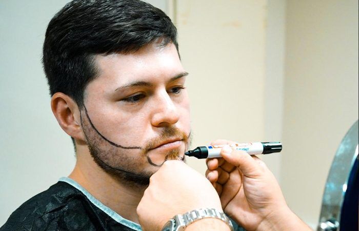 Beard Transplant Turkey 16 beard hair tranplant in turkey