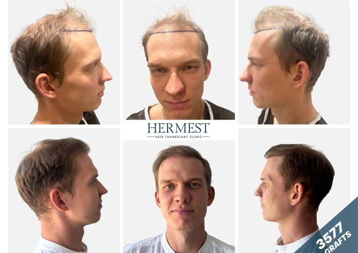 Before and after hair transplant photo showing the results of 3,500 grafts.